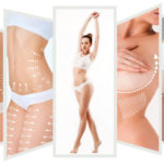 Ultrasound Cavitation & Radio Frequency